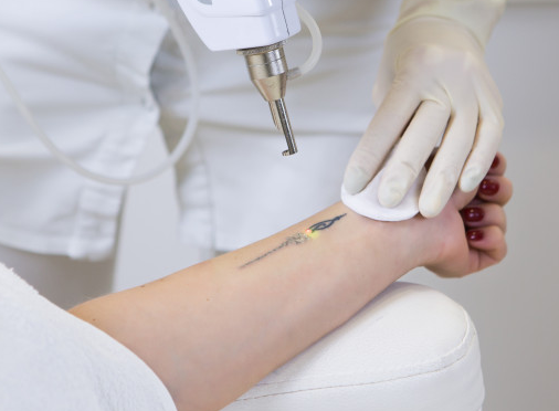 How Long Does Laser Tattoo Removal Take?
